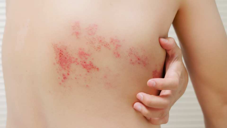 shingles treatment in tooting