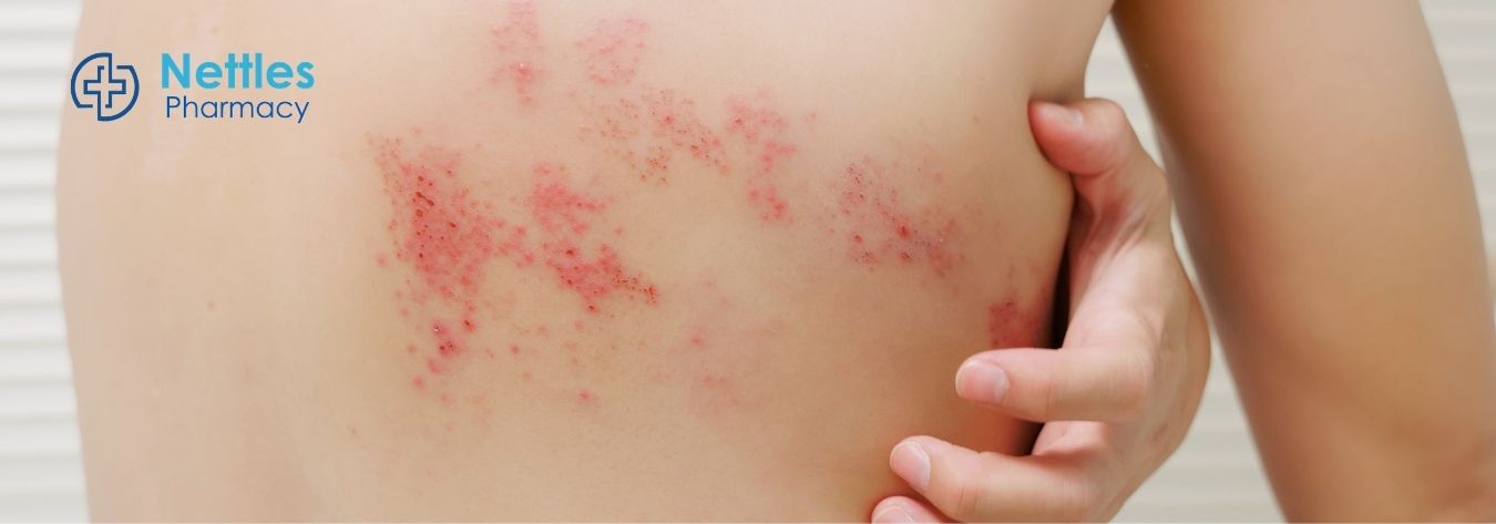 Shingles rash on back