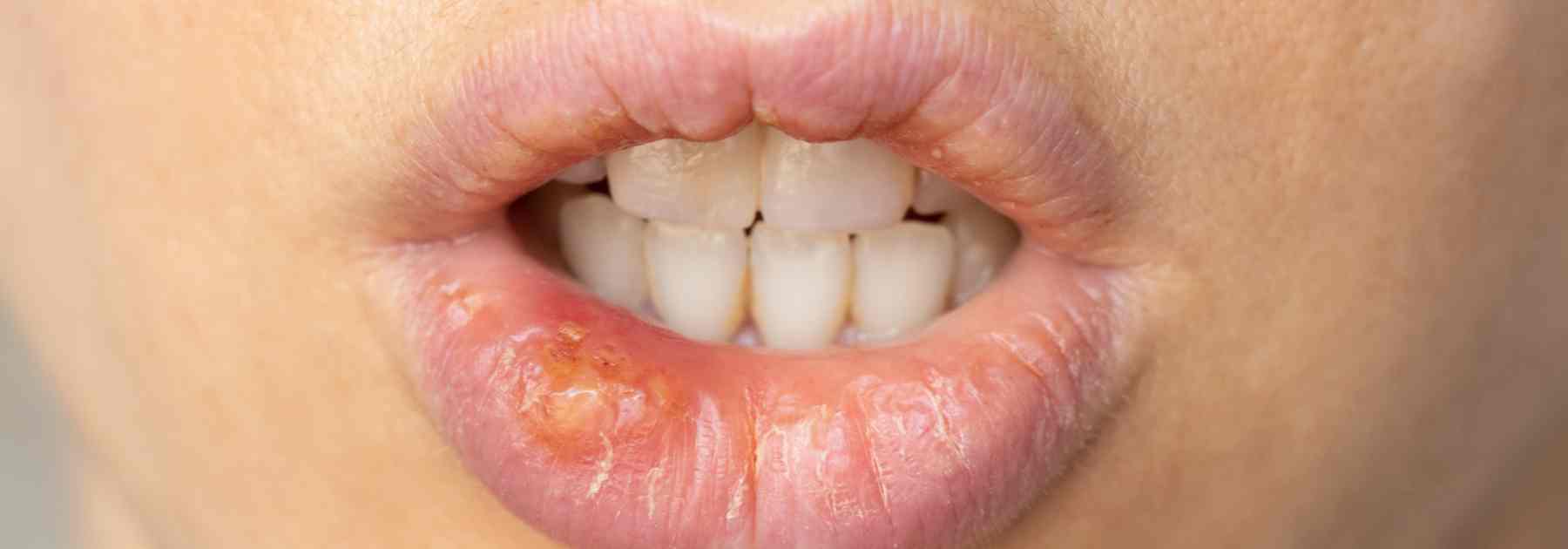 Cold sore on a lip